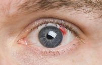 Диабетическая ангиопатия сетчатки: причины поражения глаз и лечение