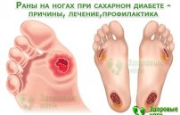 Лечение ран на ногах при сахарном диабете