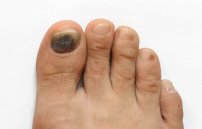 У диабетика на ногтях появились темные пятна: почему чернеют пальцы ног?