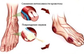 Болят ноги при диабете что делать, лечение, осложнения