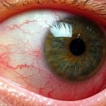ангиопатия глаз