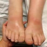 Отек ноги в голеностопе при диабете thumbnail
