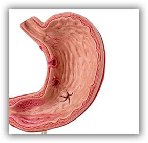 Перфорация желудка. Прободение язвы желудка.