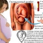 Гестационный диабет у беременных