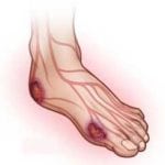 Потемнение пальца ноги при сахарном диабете thumbnail