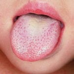Язык при сахарном диабете: фото язв во рту