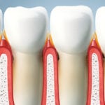 Пародонтит при сахарном диабете: лечение выпадения зубов