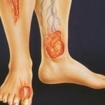 Гниют ноги при сахарном диабете: как лечить осложнение на конечностях?