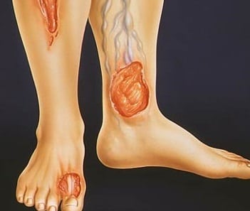 Гниет нога при сахарном диабете: сепсис и коросты на ногах ...