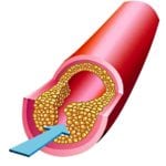 Атеросклероз нижних конечностей лечение с сахарным диабетом thumbnail
