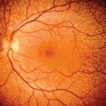 Диабетическая ангиоретинопатия сетчатки: что это, ка проявляется поражение зрения?