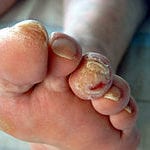 Лечение воспаления ноги при сахарном диабете thumbnail