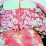 Покраснение во рту при диабете thumbnail