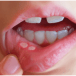 Профилактика полости рта при сахарном диабете thumbnail