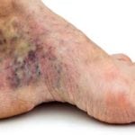 Воспаление ног при диабете лечение thumbnail