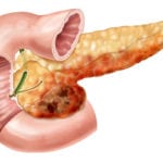 Вторичная экзокринная недостаточность поджелудочной железы thumbnail