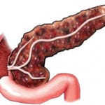 Стромальный компонент в поджелудочной железе thumbnail