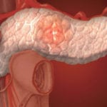 Нарушение секреции поджелудочной железы лечение thumbnail