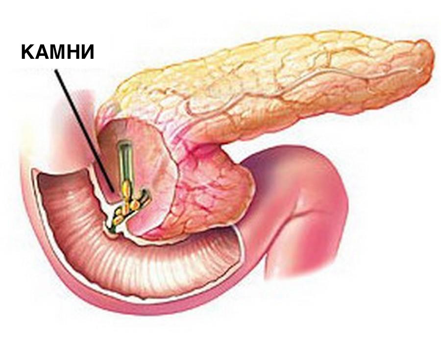Панкреатит и язва желудка. Острый билиарный панкреатит. Камни в панкреатическом протоке. Обтурация протоков поджелудочной железы.