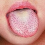 Цвет языка при панкреатите: фото налета