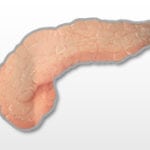 Диффузные изменения поджелудочной железы по типу жировой инфильтрации