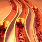 При облитерирующем атеросклерозе в первую очередь поражаются артерии thumbnail