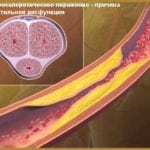 Атеросклероз сосудов и капилляров полового члена: симптомы и лечение